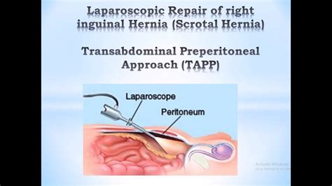 Transabdominal Preperitoneal Approach - TAPP - YouTube