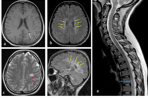 Multiple Sclerosis – Radiology Cases