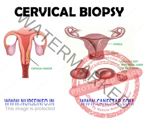 CERVICAL BIOPSY - Nurse Info