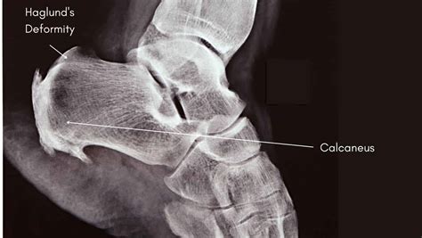 Retrocalcaneal Bursitis: Explained by a Physical Therapist