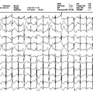 Ventricular bigeminy was seen at the peak heart rate during exercise... | Download Scientific ...