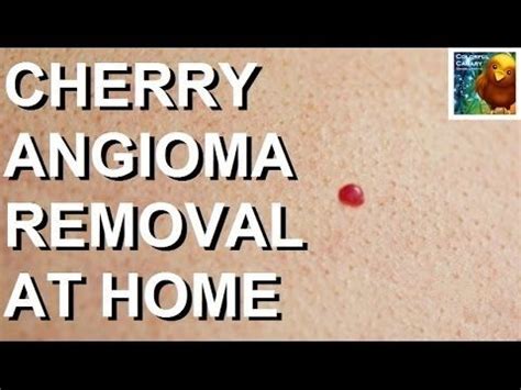 Pin by Jill Martin on Pcos | Cherry angioma removal, Cherry angioma, Skin care techniques