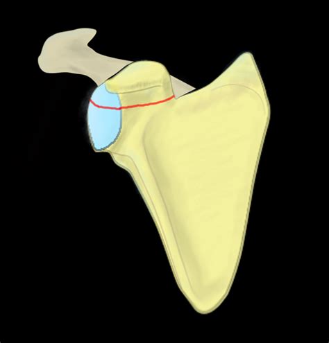 Fractures of glenoid of scapula - Ideberg classification | Classifications, online calculators ...