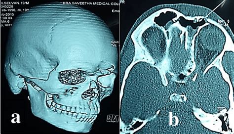 Frontal Sinus Bone Fracture