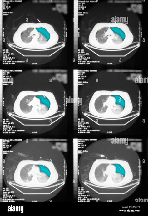 Pneumothorax Ct Scan