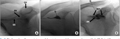 Figure 1 from A New Anterior Approach for Fluoroscopy-guided Suprascapular Nerve Block - A ...