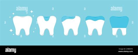 Tooth dental inlay, onlay, overlay and crown treatment set Stock Vector ...