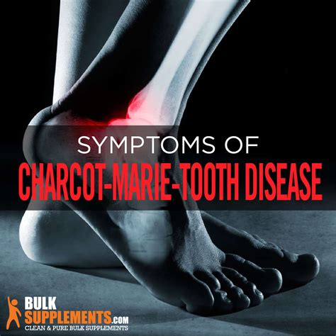 Charcot-Marie-Tooth Disease Symptoms and Treatment