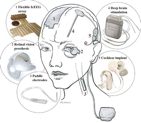 What Are Neural Implants? - Deltec Bank and Trust