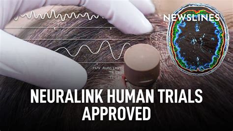 Neuralink human trials approved – Newslines