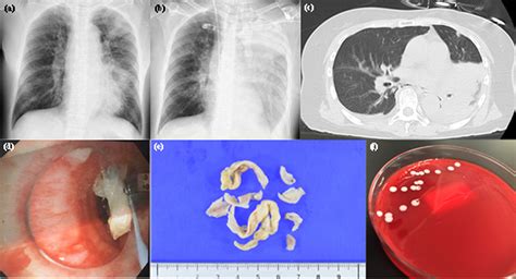 Corynebacterium ulcerans pneumonia treated with venovenous ...