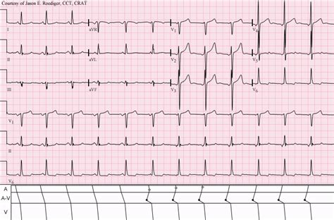 Wandering atrial pacemaker - Wikipedia