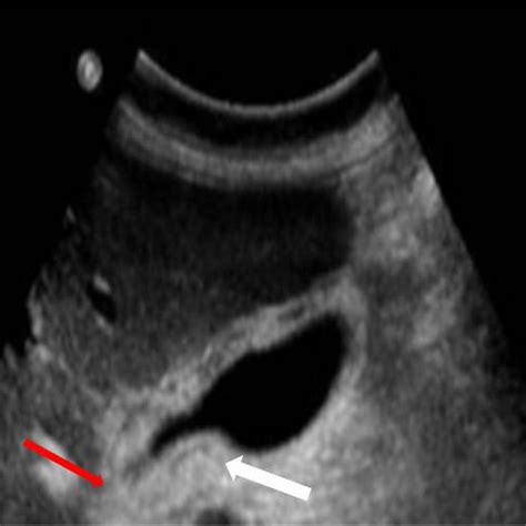 An abdominal ultrasonography is showing gall bladder and ductus... | Download Scientific Diagram