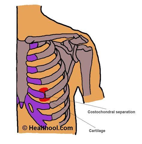 Costochondral Separation - Symptoms, Diagnosis, Treatment - (2018 ...