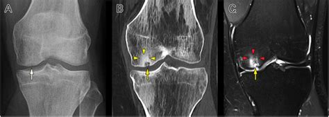 Cyst formation in the subchondral bone following cartilage repair - Gao ...