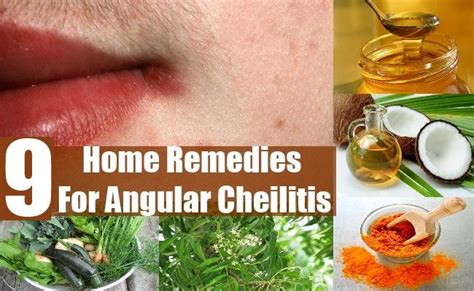 Home Remedies For Angular Cheilitis | Daily health tips, Remedies, Home remedies