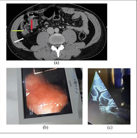 Unexpected rapid symptom response after praziquantel to intestinal ...