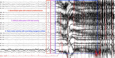 Generalized Seizure Eeg