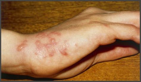 Pictures of shingles on arm | Shingles Expert