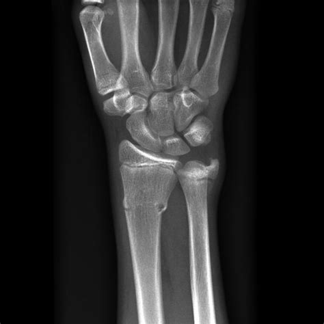 Distal radius and ulnar fractures | Radiology Case | Radiopaedia.org