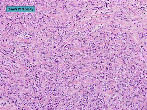 Qiao's Pathology: Invasive Lobular Carcinoma with Extracel… | Flickr