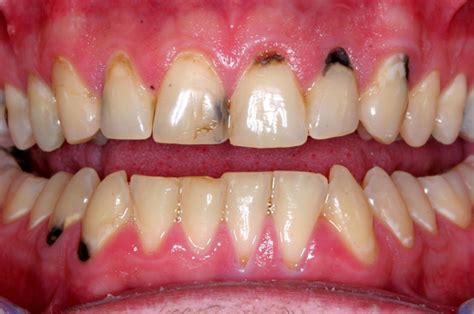 Black Spot on Gums Near Tooth: Learn What Causes Dark Spots on Gums