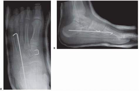 Calcaneal Lengthening Osteotomy for the Treatment of Hindfoot Valgus Deformity | Musculoskeletal Key