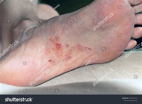 Female Foot Eczema Wound Dermatitis Skin Foto stock 1991583152 ...