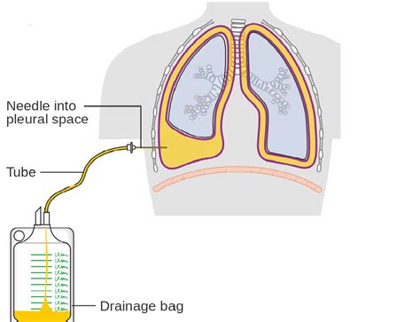 Catheter To Drain Fluid From Lungs - Best Drain Photos Primagem.Org