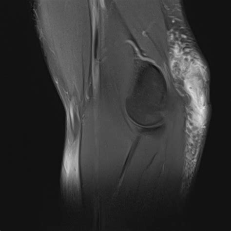 Bursitis MRI - wikidoc