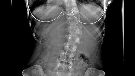 Scoliosis X Ray Before And After