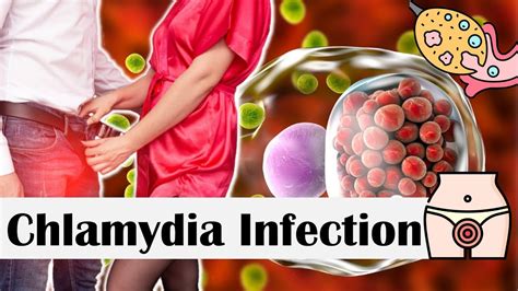 Chlamydia Infection - Causes, Risk Factors, Transmission, Signs & Symptoms, Diagnosis ...