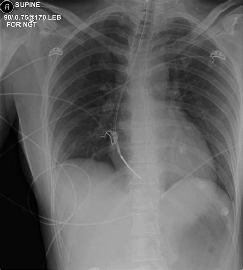 Chest Tube X Ray