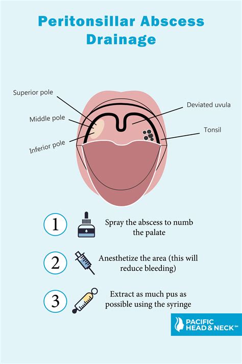 Deviated Uvula Sore Throat