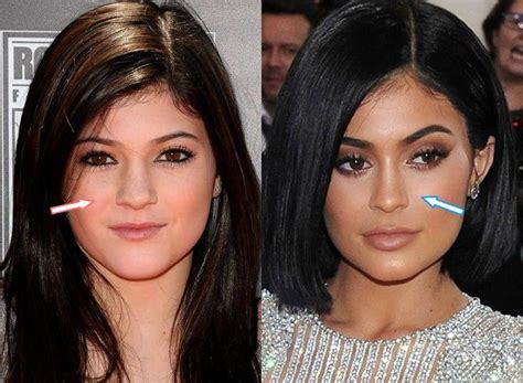 Kylie Jenner - Nose Job - before and after surgery #plasticsurgery ...