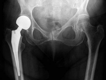 Partial Hip Replacement - Physiopedia