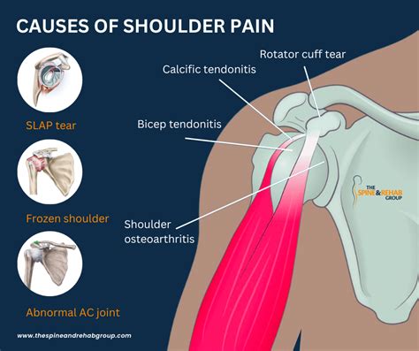 How to Resolve Right Neck and Shoulder Pain | The Spine & Rehab Group