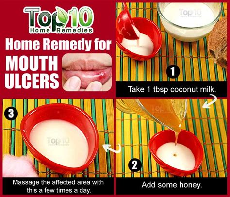 Home Remedies for Mouth Ulcers | Top 10 Home Remedies