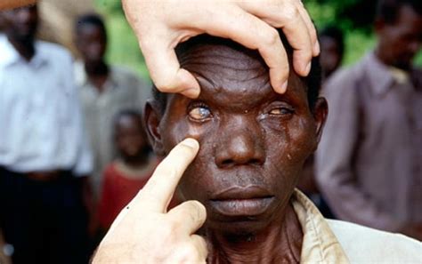 Over 1m blind adults live in Nigeria — Nzelu - Vanguard News