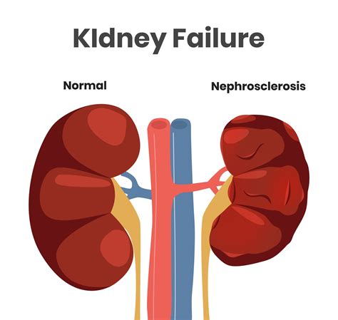 Kidney Failure and Vascular Disease — Vascular Cures