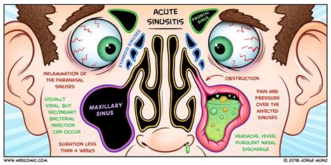 Acute Sinusitis BY JORGE MUNIZ, PA-C medcomic.com | Acute sinusitis, Sinusitis, Nursing mnemonics