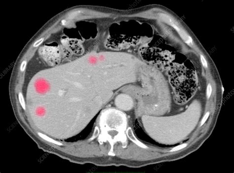 Liver Metastasis - Stock Image - C002/9991 - Science Photo Library