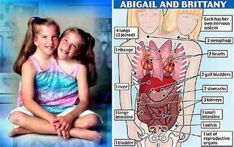 The anatomy of conjoined twins Brittany and Abigail : r ...