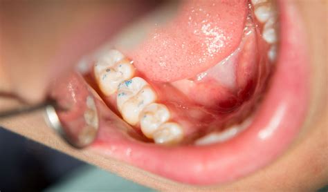 Occlusal-Adjustment - Fabey Dental