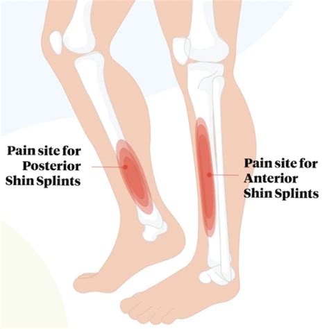 Shin Splints | Symptoms and Treatment Guide | QSMC