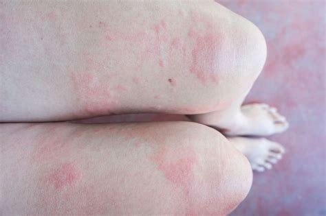 Stress Rash: Spotting & Treating It (Photo Examples)