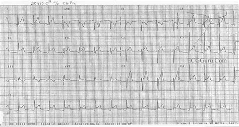 Pericarditis | ECG Guru - Instructor Resources