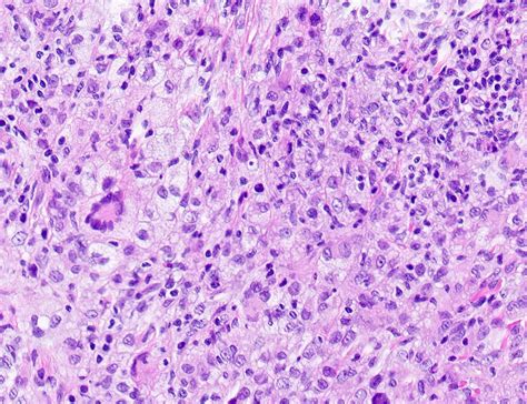 Pathology Outlines - Juvenile xanthogranuloma