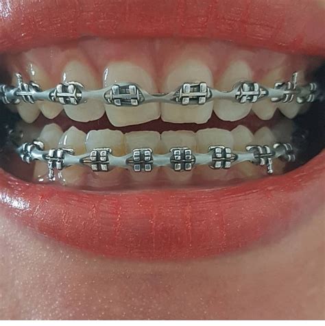 Pin by elpotrillo31 on mouth braces | Braces colors, Teeth braces, Dental braces