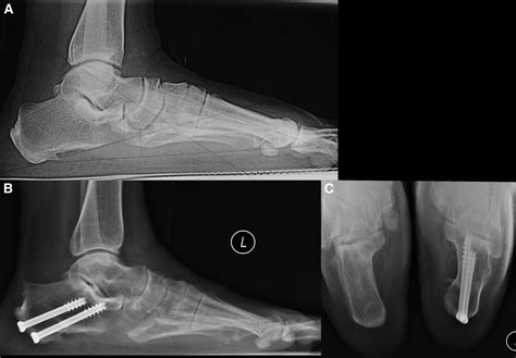 Percutaneous Posterior Calcaneal Osteotomy - The Journal of Foot and ...